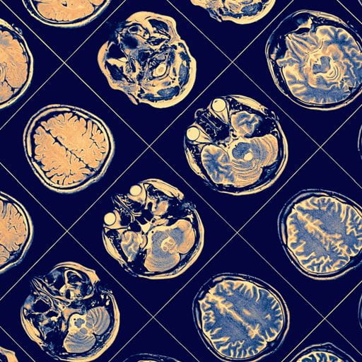 A sequence of MRI brain scans on a blue background, detailing brain imaging.