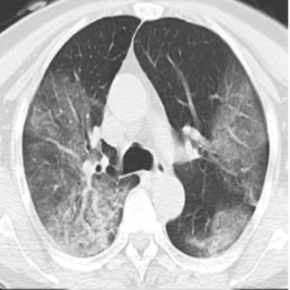 A black and white CT Scan.