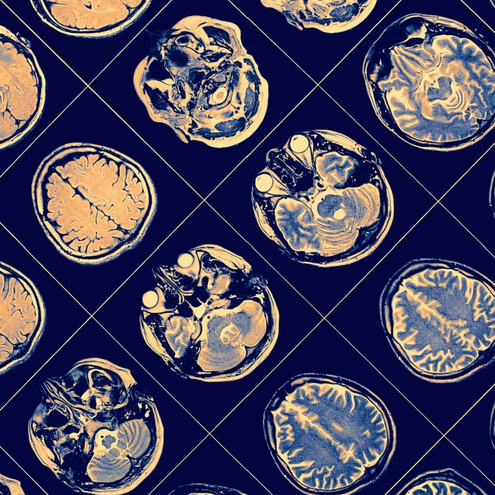 A sequence of MRI brain scans on a blue background, detailing images of a brain.