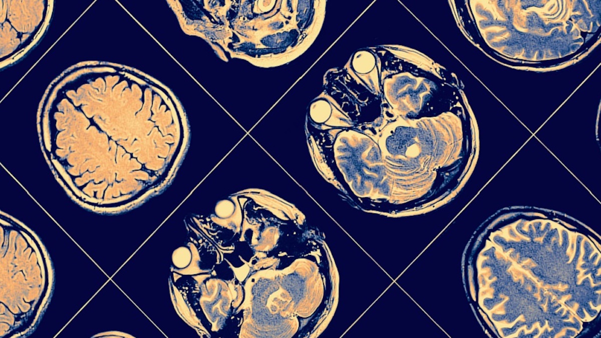Brain imagery scan)