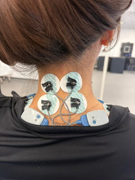 A person with their back to the camera, with six small sensors on the back of their neck.